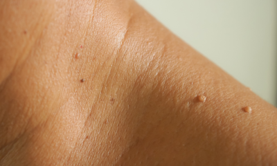 Complete Guide to Skin Tag Removal: Options, Risks, and Care