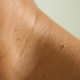 Complete Guide to Skin Tag Removal: Options, Risks, and Care