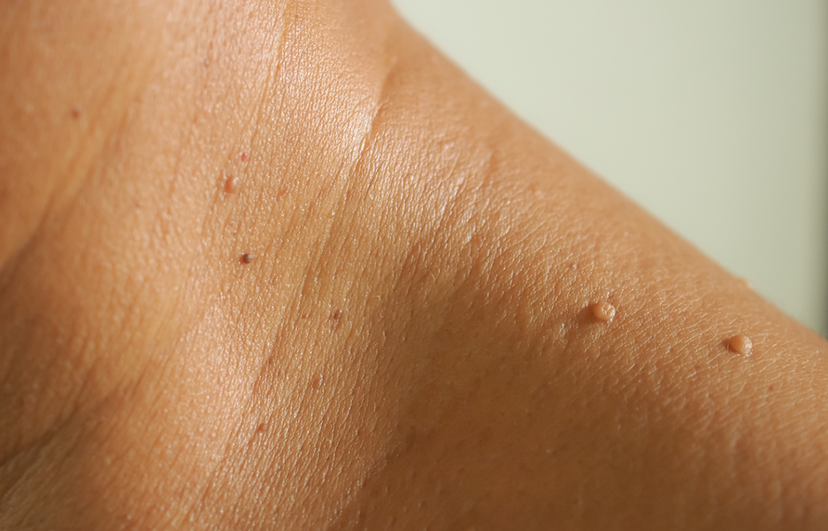 Complete Guide to Skin Tag Removal: Options, Risks, and Care