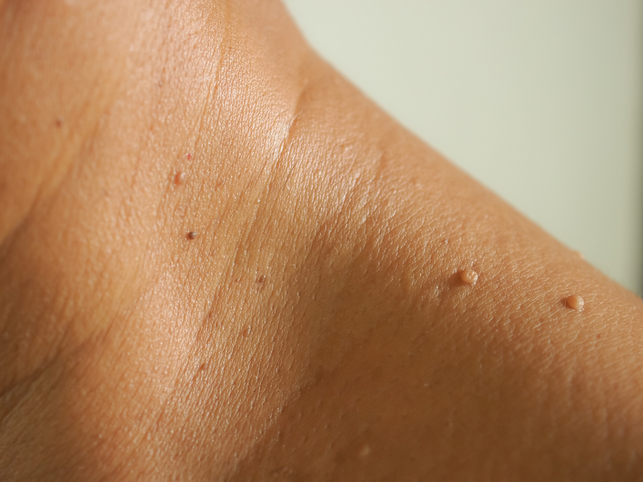 Complete Guide to Skin Tag Removal: Options, Risks, and Care